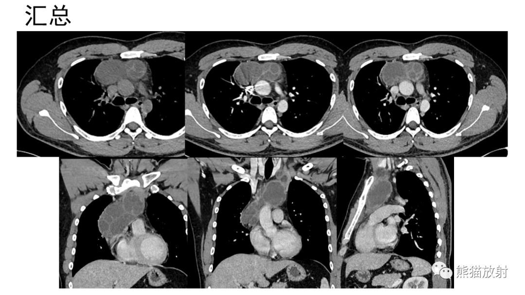 【病例】前纵隔畸胎瘤2例CT影像-6