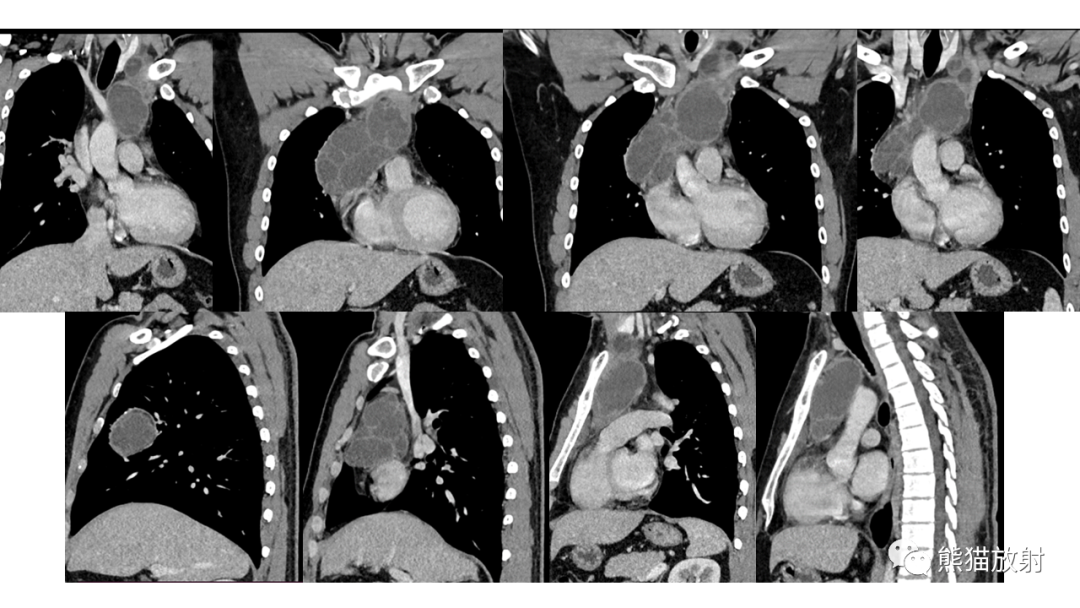 【病例】前纵隔畸胎瘤2例CT影像-5