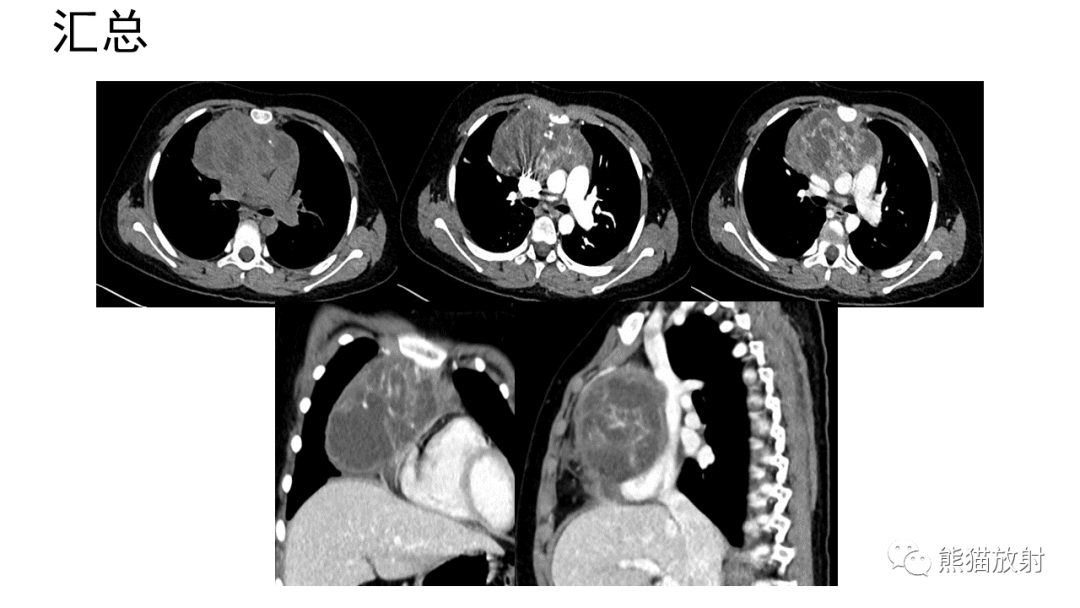 【病例】前纵隔畸胎瘤2例CT影像-14