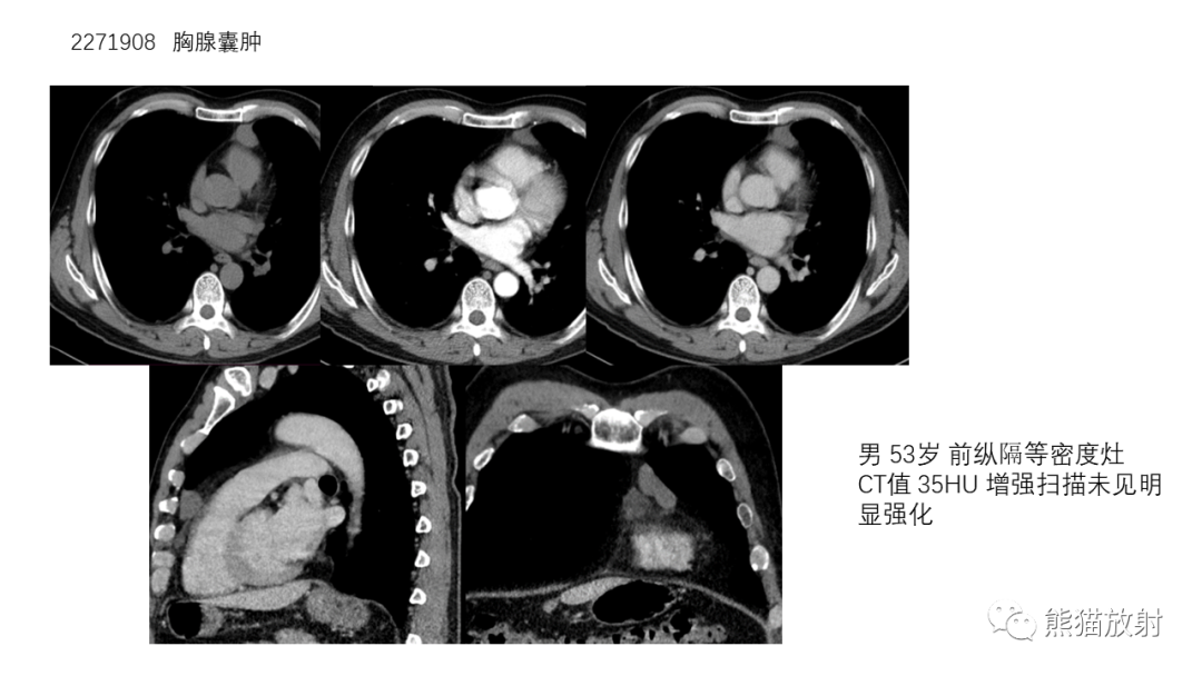 【病例】前纵隔畸胎瘤2例CT影像-27