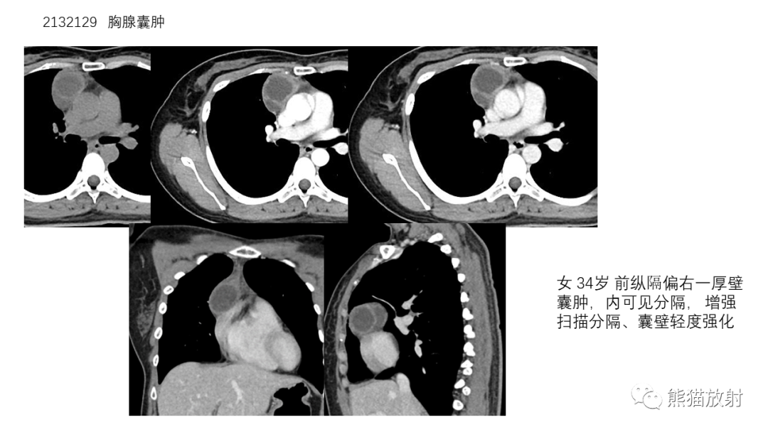 【病例】前纵隔畸胎瘤2例CT影像-28