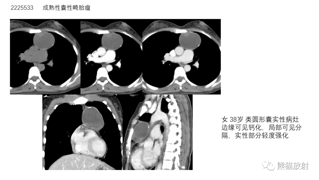 【病例】前纵隔畸胎瘤2例CT影像-22