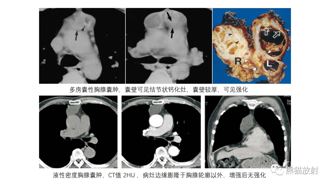 【病例】前纵隔畸胎瘤2例CT影像-29