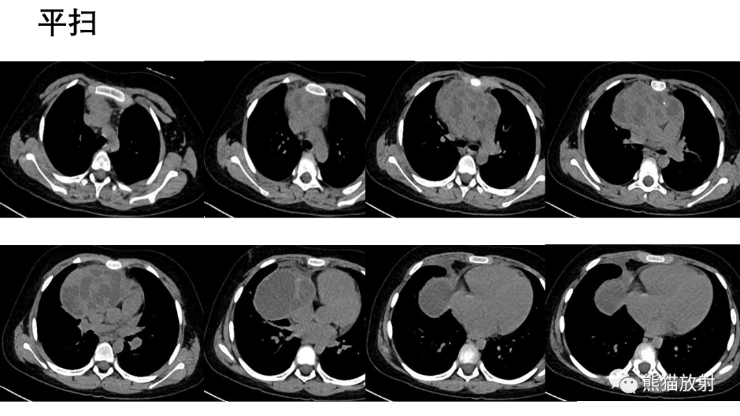 【病例】前纵隔畸胎瘤2例CT影像-11