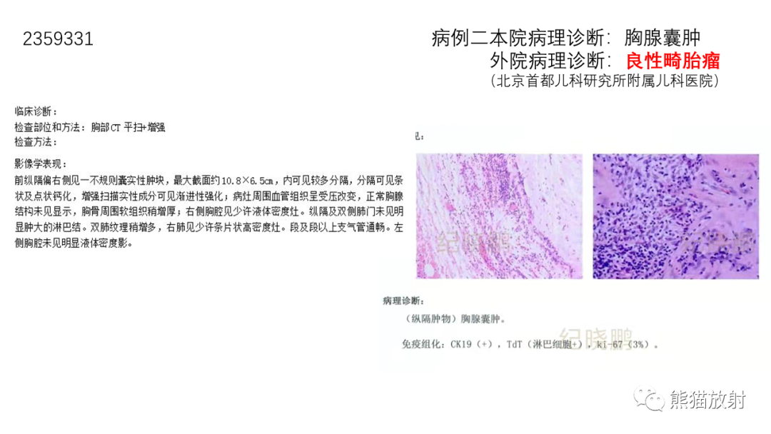 【病例】前纵隔畸胎瘤2例CT影像-18