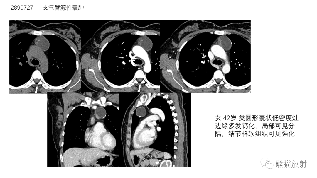 【病例】前纵隔畸胎瘤2例CT影像-32
