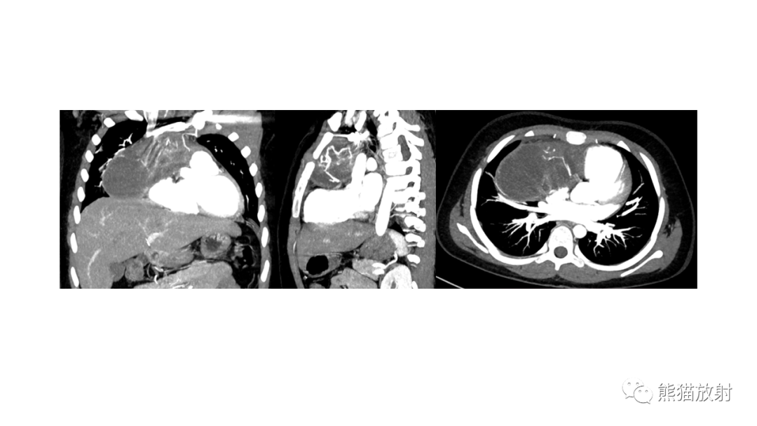 【病例】前纵隔畸胎瘤2例CT影像-13