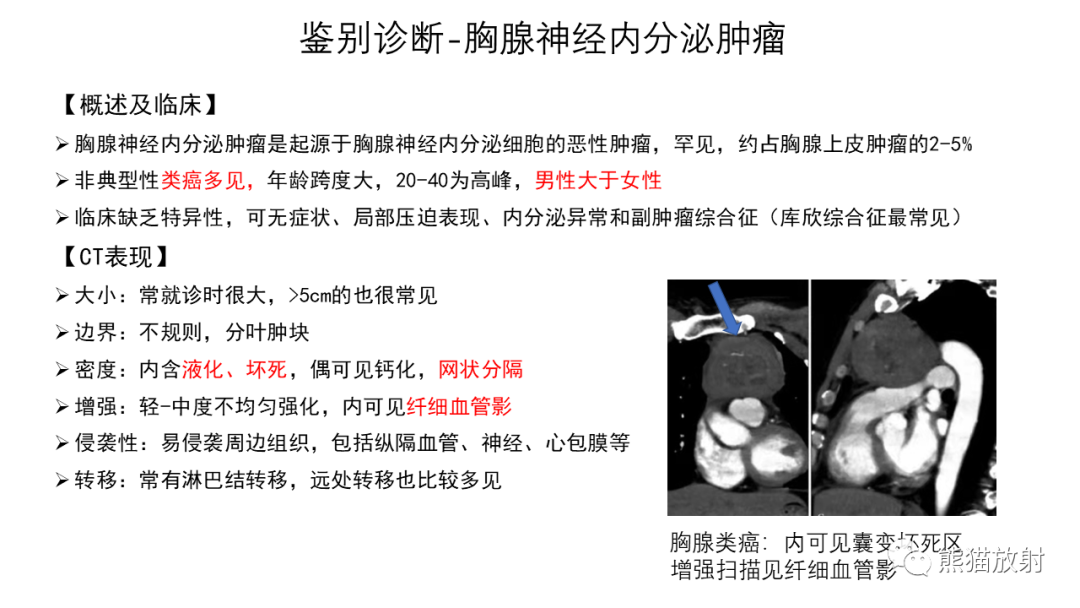 【病例】前纵隔畸胎瘤2例CT影像-30