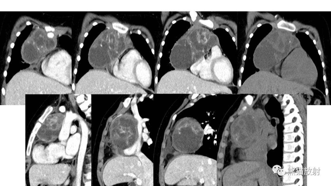 【病例】前纵隔畸胎瘤2例CT影像-12