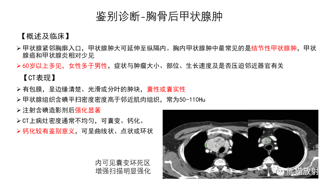 【病例】前纵隔畸胎瘤2例CT影像-34