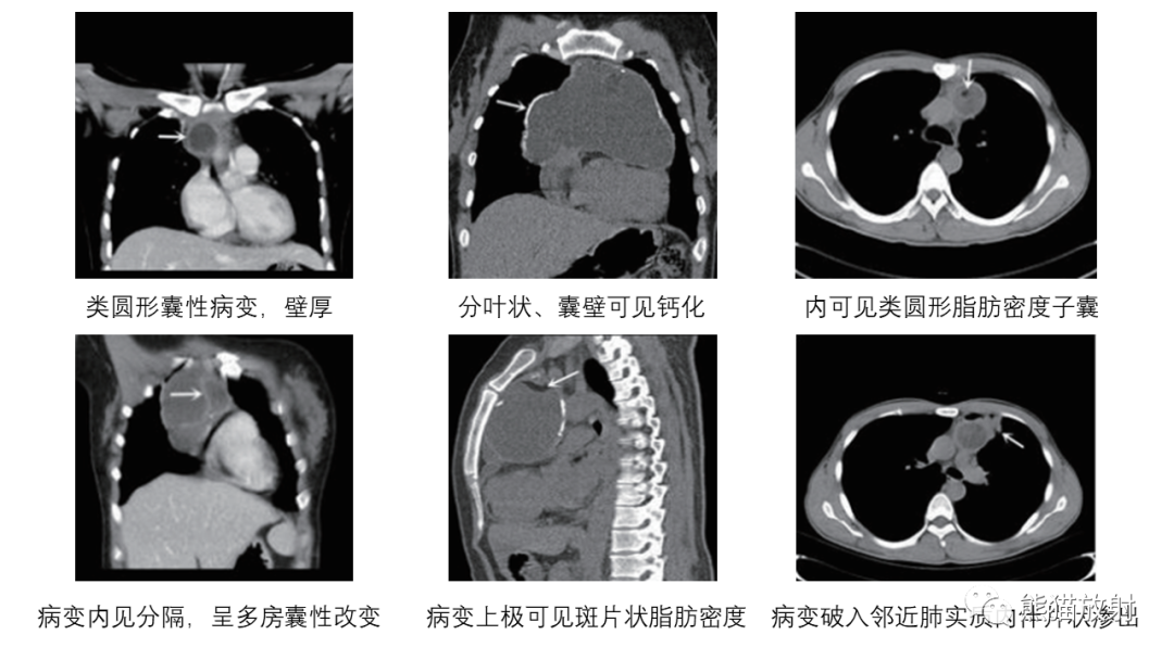 【病例】前纵隔畸胎瘤2例CT影像-23