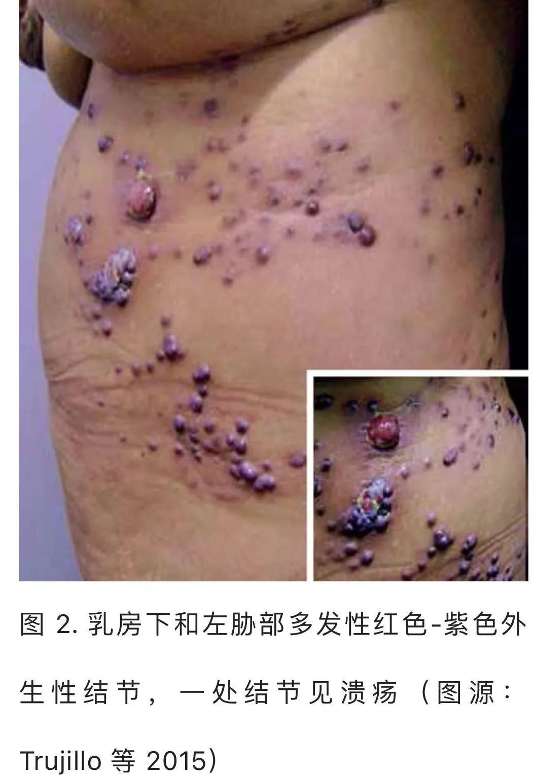 【病例】HIV卡波西肉瘤1例肺部影像表现-27