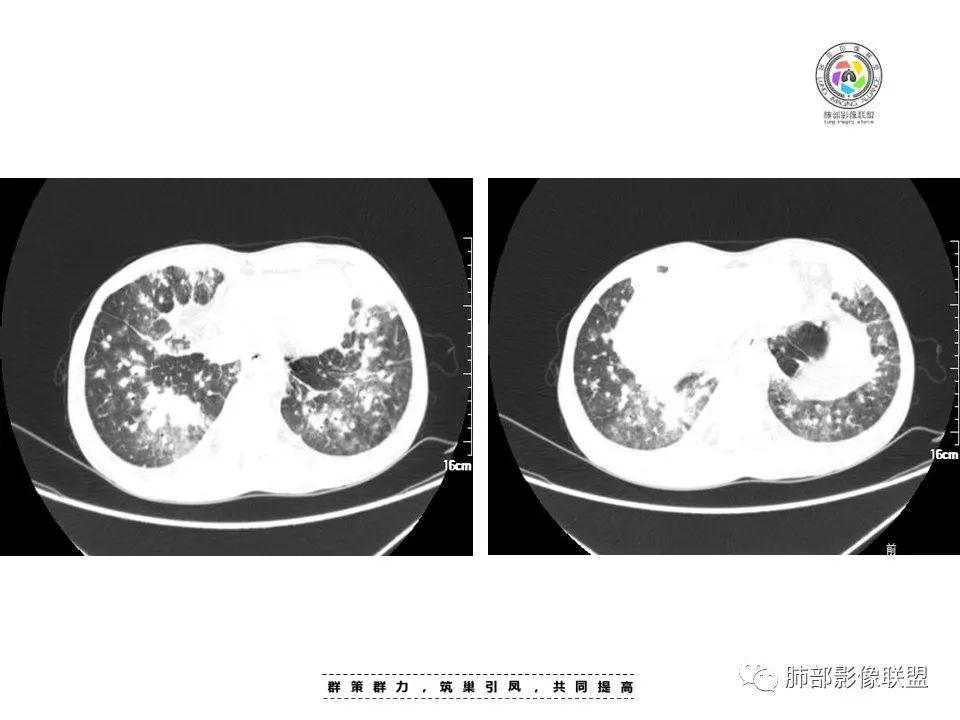 【病例】HIV卡波西肉瘤1例肺部影像表现-10