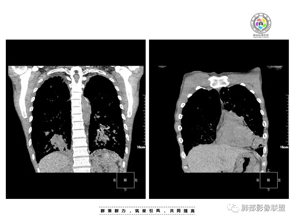 【病例】HIV卡波西肉瘤1例肺部影像表现-20