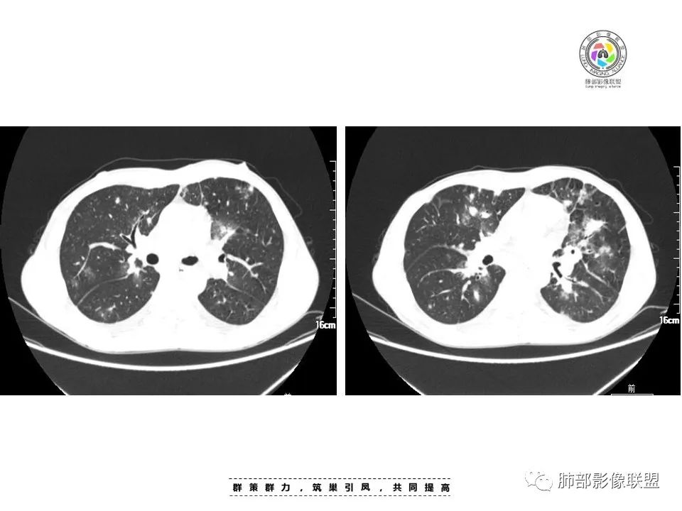 【病例】HIV卡波西肉瘤1例肺部影像表现-7
