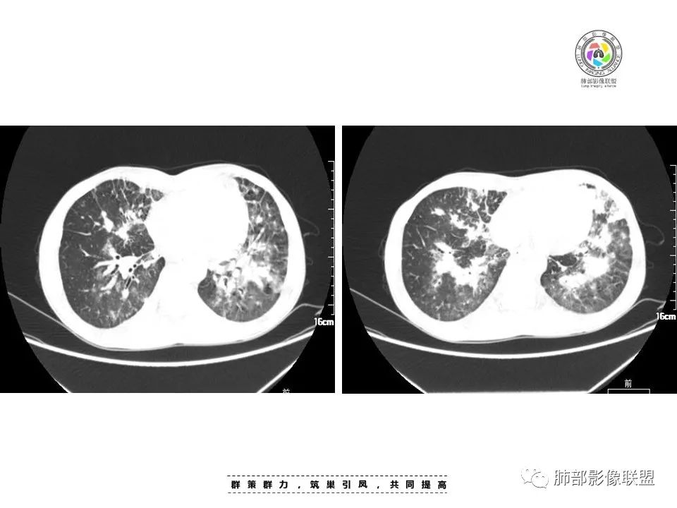 【病例】HIV卡波西肉瘤1例肺部影像表现-9
