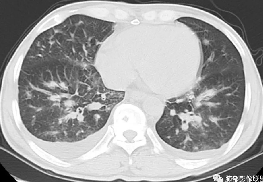 【病例】HIV卡波西肉瘤1例肺部影像表现-29