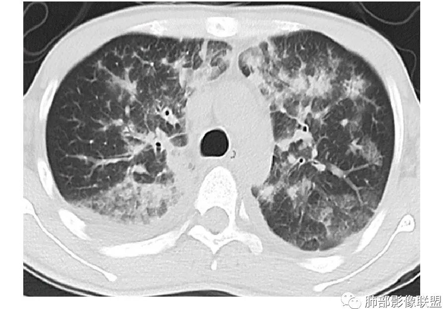 【病例】HIV卡波西肉瘤1例肺部影像表现-30