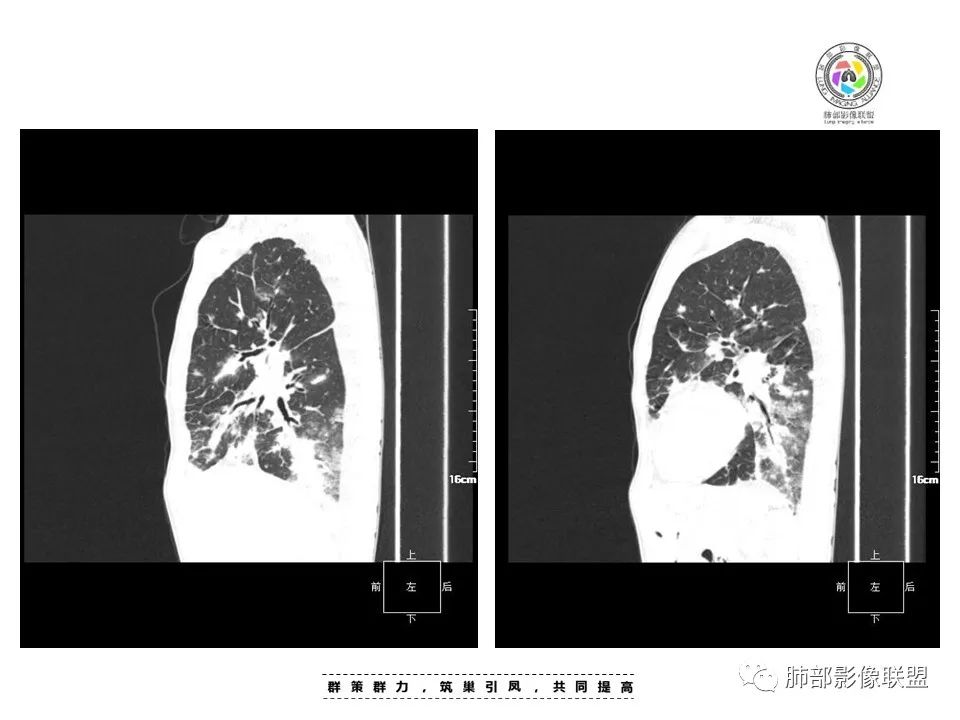【病例】HIV卡波西肉瘤1例肺部影像表现-15