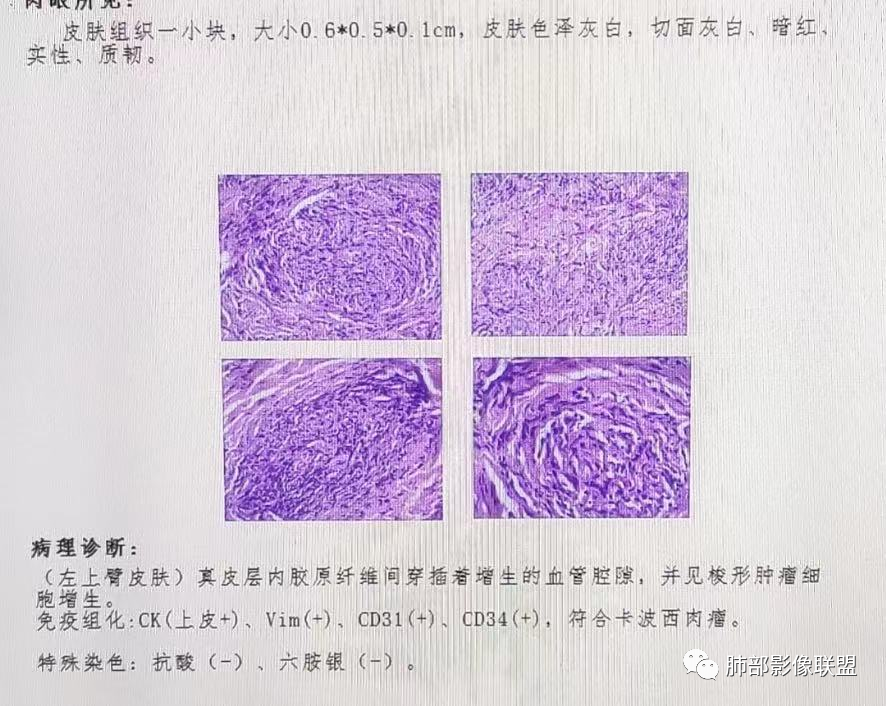 【病例】HIV卡波西肉瘤1例肺部影像表现-26