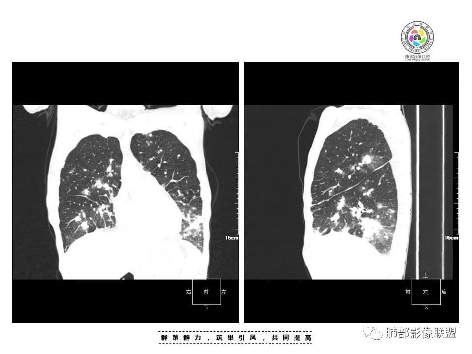 【病例】HIV卡波西肉瘤1例肺部影像表现-14