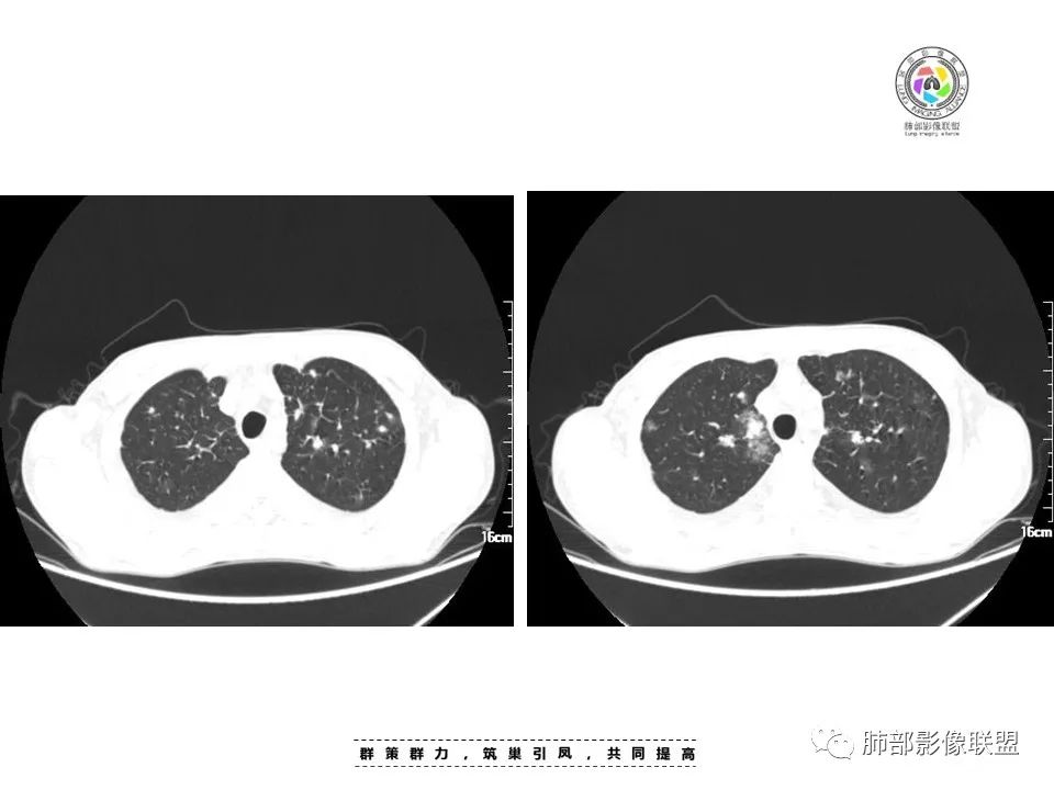 【病例】HIV卡波西肉瘤1例肺部影像表现-5
