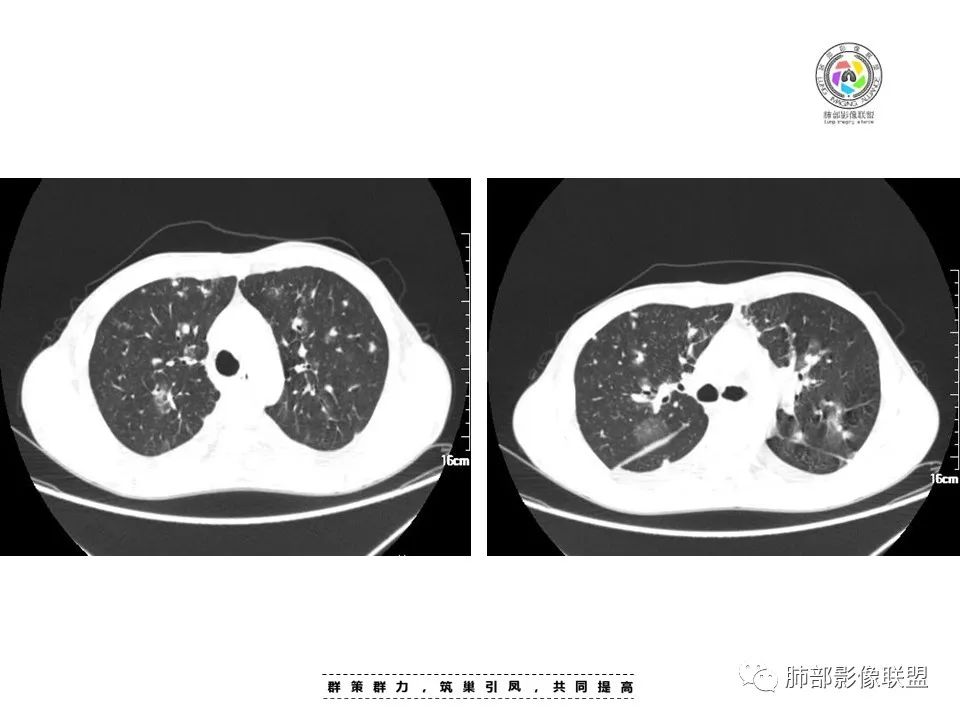 【病例】HIV卡波西肉瘤1例肺部影像表现-6