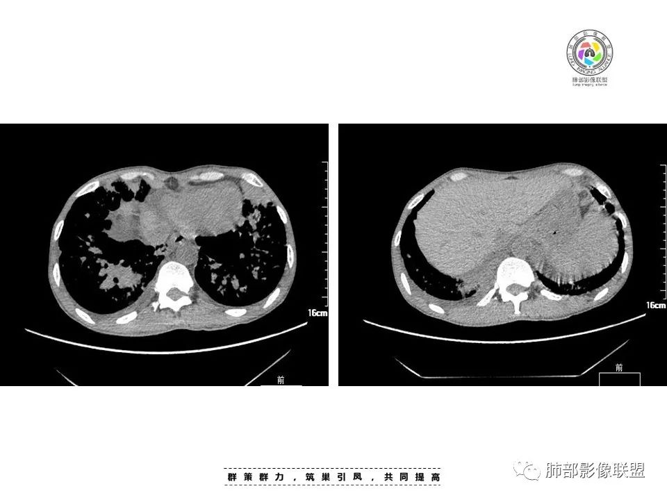 【病例】HIV卡波西肉瘤1例肺部影像表现-19