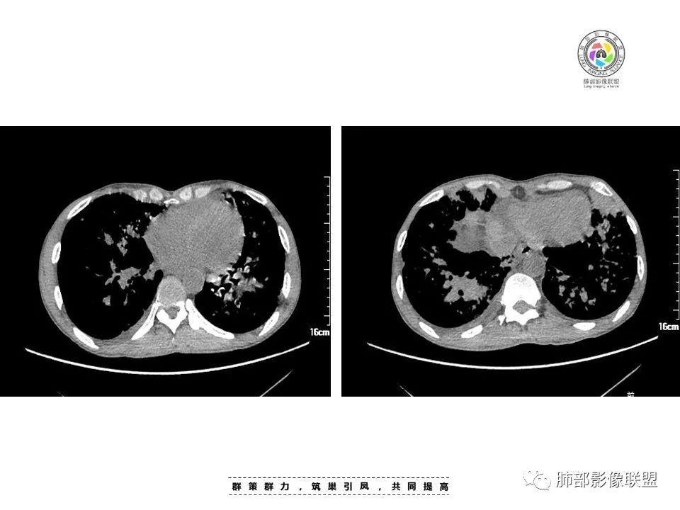 【病例】HIV卡波西肉瘤1例肺部影像表现-18