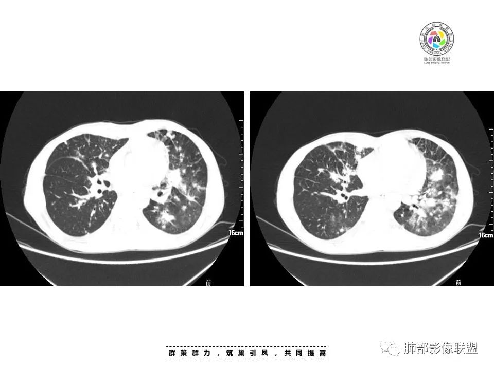 【病例】HIV卡波西肉瘤1例肺部影像表现-8