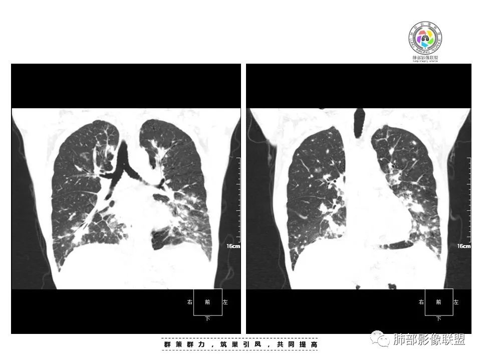 【病例】HIV卡波西肉瘤1例肺部影像表现-13