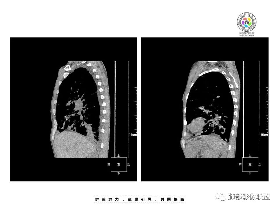 【病例】HIV卡波西肉瘤1例肺部影像表现-21
