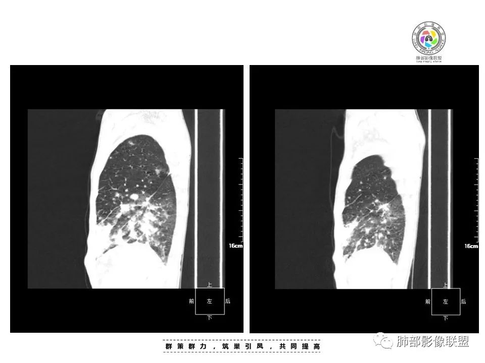 【病例】HIV卡波西肉瘤1例肺部影像表现-16
