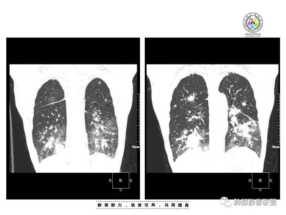 【病例】HIV卡波西肉瘤1例肺部影像表现-12