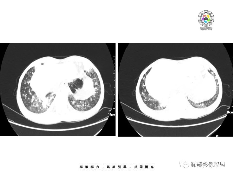 【病例】HIV卡波西肉瘤1例肺部影像表现-11