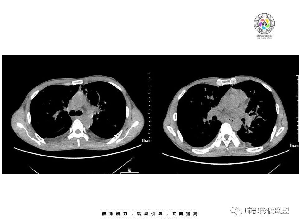【病例】HIV卡波西肉瘤1例肺部影像表现-17