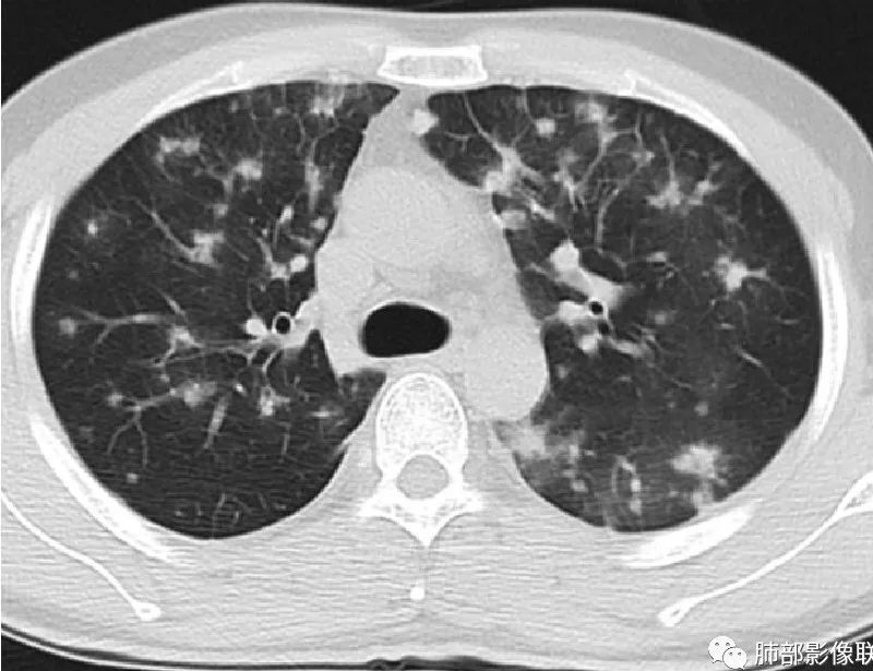 【病例】HIV卡波西肉瘤1例肺部影像表现-28