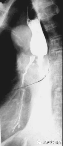 一定要小心食管的\