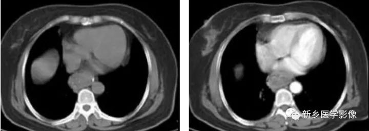 一定要小心食管的\
