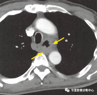 一定要小心食管的\