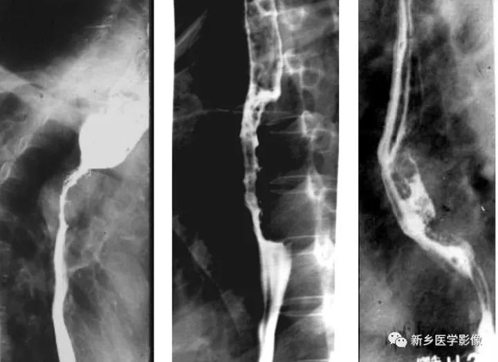 一定要小心食管的\
