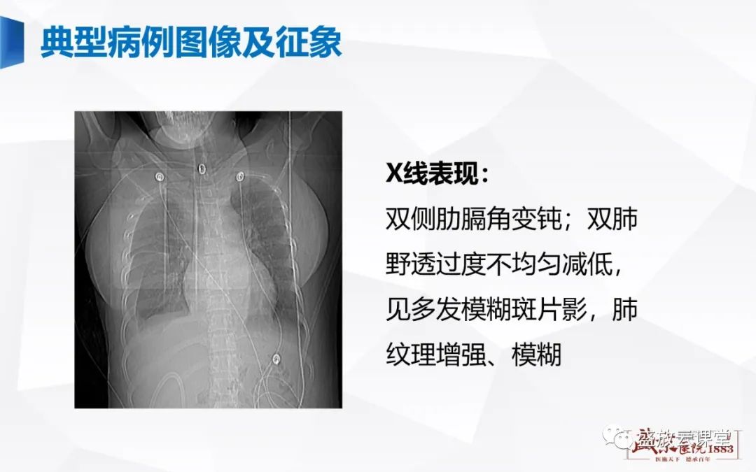 【PPT】胸膜病变-17