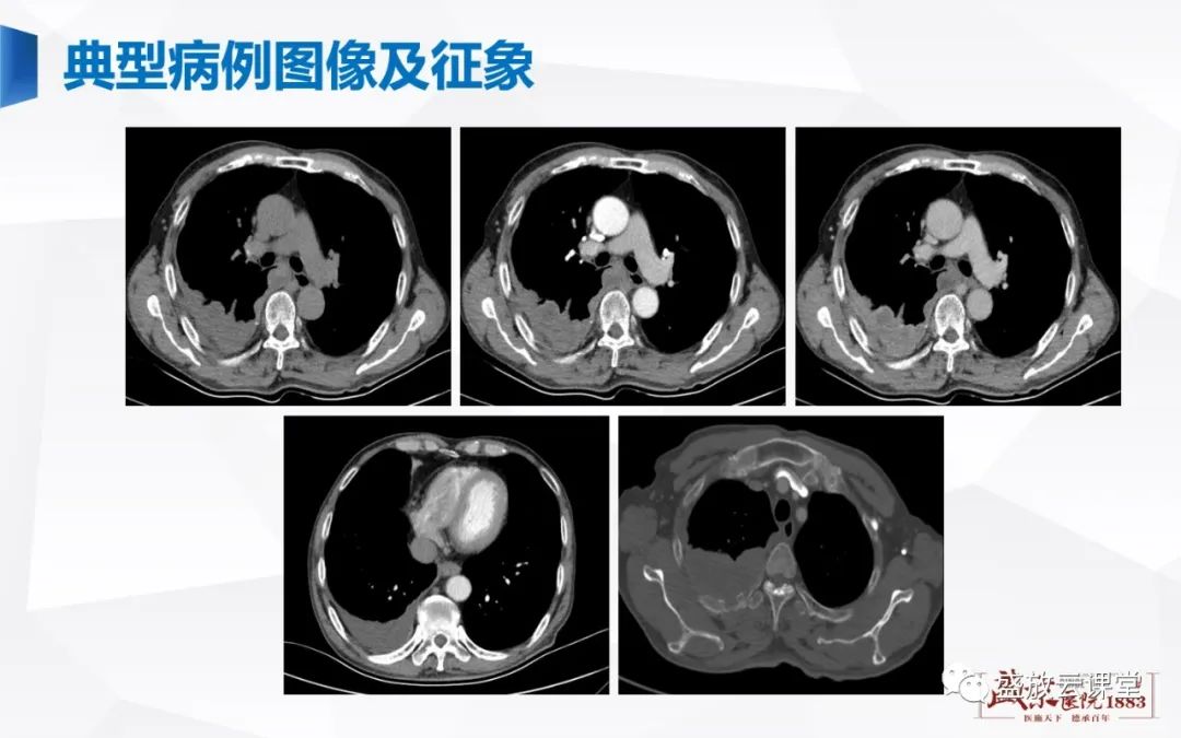 【PPT】胸膜病变-8