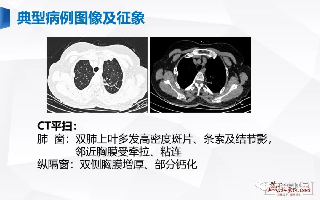 【PPT】胸膜病变-29