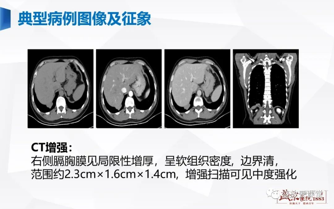 【PPT】胸膜病变-4