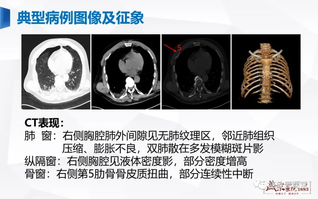 【PPT】胸膜病变-23