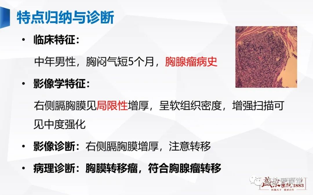 【PPT】胸膜病变-6