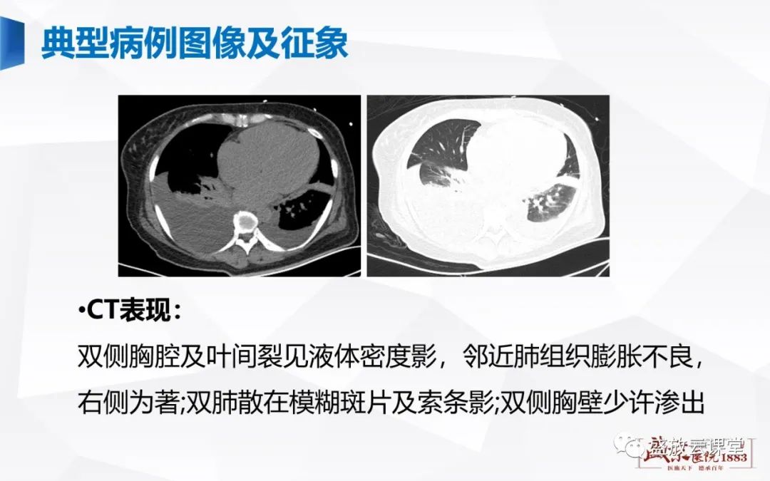 【PPT】胸膜病变-18