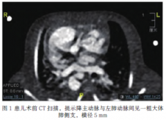 <b>内脏异位综合征患儿围手术期灾难性血流动力学</b>