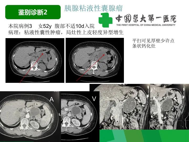 【病例】胰腺实性假乳头状瘤1例CT及MR影像-30